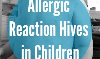 Allergic Reaction Hives in Children