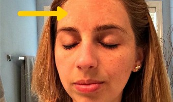 Pregnancy Melasma