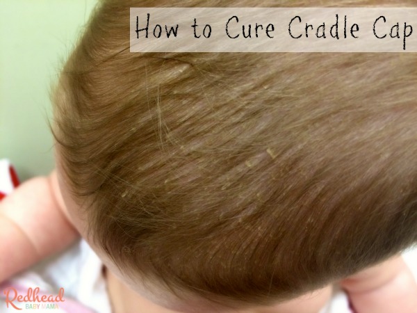 How to Cure Cradle Cap